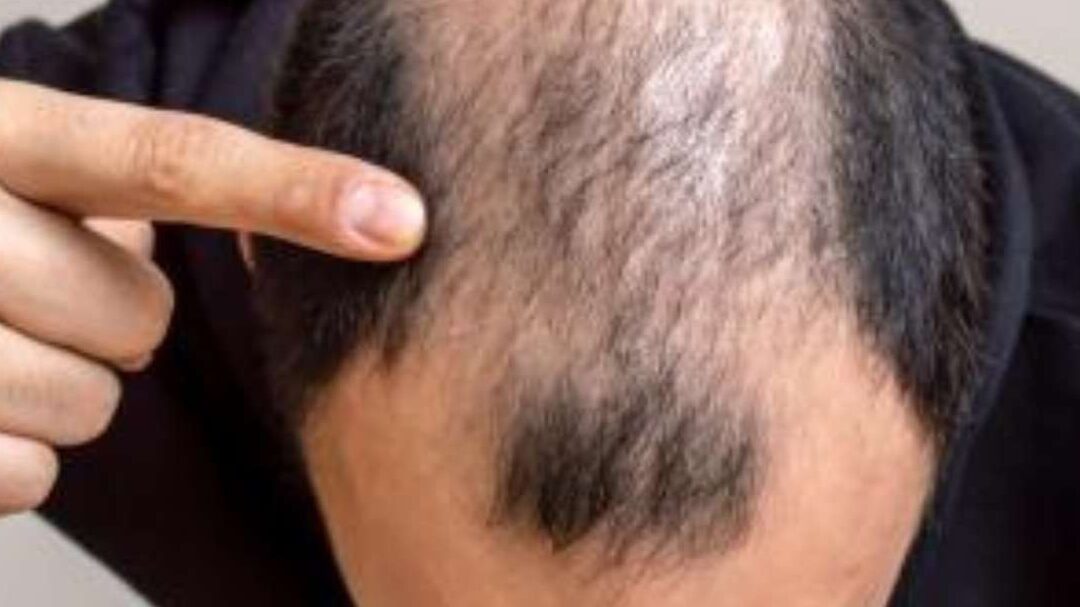 ¿Qué Significa Soñar Que Te Quedas Calvo?
